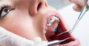 Orthodontics in Noida by Floss Dental